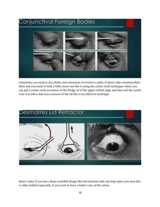 18
sometimes you need to do a better true retraction reversion to really if there's that sensation that's
there and you need to look a little closer um this is using the cotton swab technique where you
can put a cotton swab you know at the bridge of of the upper orbital ridge and then roll the eyelid
over it to allow that true eversion of the lid this is an effective technique
there's other if you have these available things like lid retractors that can help open your area this
is often helpful especially if you want to have a better view of the sclera
 