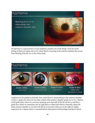 42
all right here is a great picture of your hyphema certainly one of the things i look for in the
setting of blunt eye injury and so it's where blood is layering in the anterior chamber this occurs
from bleeding from the iris or the ciliary body.
hyphema can be graded on basically how much blood is accumulating in the anterior chamber.
so this is grade one where it's less than a third of the anterior chamber grade two or it's a third to
a half grade three where it's you know pushing more than half of the the uh the ac and then a
grade four which we sometimes call an eight ball or a black ball which is basically where the
entire anterior chamber is covered with blood if you look at that eye on the right it's highly
suspicious for a rupture there's a circumferential subconjuctival hemorrhage and there's blood
 