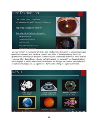 44
um okay so that's hyphema and let's talk a little bit about lens dislocation so lens dislocation can
occur from trauma we also you know certainly have heard of this as something that occurs
spontaneously specifically with certain systemic diseases like the ones mentioned below marfans
syndrome ehlers-danlos homocystinuria etc but in general you can usually see this pretty clearly
um in the pupil as a dislocation of that lens and often see the edge you can also sometimes see it
on a ct scan where you can see separation if there's in the setting of a significant trauma.
 