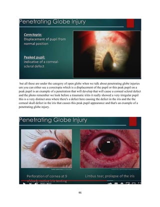46
but all these are under the category of open globe when we talk about penetrating globe injuries
um you can either see a corectopia which is a displacement of the pupil or this peak pupil on a
peak pupil is an example of a penetration that will develop that will cause a corneal scleral defect
and the photo remember we look before a traumatic iritis it really showed a very irregular pupil
this is a very distinct area where there's a defect here causing the defect in the iris and the the
corneal skull defect in the iris that causes this peak pupil appearance and that's an example of a
penetrating globe injury.
 