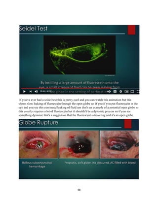 48
if you've ever had a seidel test this is pretty cool and you can watch this animation but this
shows slow leaking of fluorescein through the open globe so if you if you put fluorescein in the
eye and you see this continued leaking of fluid um that's an example of a potential open globe so
this usually requires a lot of fluorescein but it shouldn't be a dynamic process so if you see
something dynamic that's a suggestion that the fluorescent is traveling and it's an open globe.
 