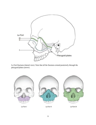 9
Le Fort fractures (lateral view). Note that all the fractures extend posteriorly through the
pterygoid plates (arrow).
 