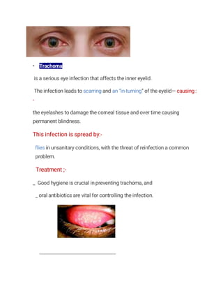 • Trachoma
is a serious eye infection that affects the inner eyelid.
The infection leads to scarring and an “in-turning” of the eyelid— causing :
-
the eyelashes to damage the corneal tissue and over time causing
permanent blindness.
This infection is spread by:-
flies in unsanitary conditions, with the threat of reinfection a common
problem.
Treatment ;-
_ Good hygiene is crucial in preventing trachoma, and
_ oral antibiotics are vital for controlling the infection.
 