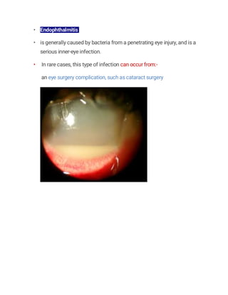 • Endophthalmitis
• is generally caused by bacteria from a penetrating eye injury, and is a
serious inner-eye infection.
• In rare cases, this type of infection can occur from:-
an eye surgery complication, such as cataract surgery
 