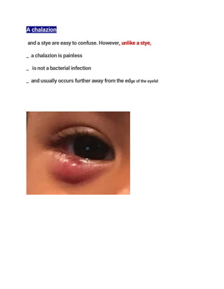 A chalazion
and a stye are easy to confuse. However, unlike a stye,
_ a chalazion is painless
_ is not a bacterial infection
_ and usually occurs further away from the edge of the eyelid
 