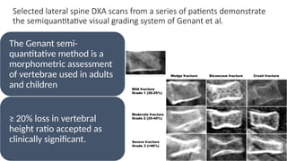 Pediatric osteoporosis Ahmed Yehia, Assistant Professor of clinical ...