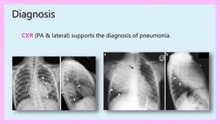 Diagnosis
CXR (PA & lateral) supports the diagnosis of pneumonia.
 