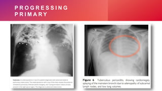 Pediatric Pulmonary Tuberculosis | PPTX