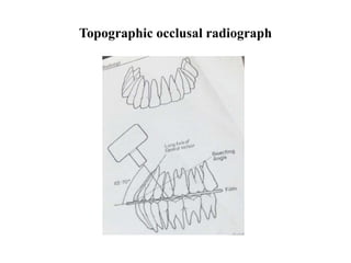 Topographic occlusal radiograph
 