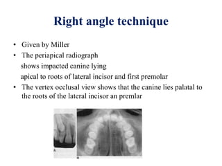 • Given by Miller
• The periapical radiograph
shows impacted canine lying
apical to roots of lateral incisor and first premolar
• The vertex occlusal view shows that the canine lies palatal to
the roots of the lateral incisor an premlar
Right angle technique
 