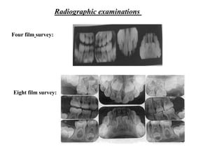 Four film survey:
Eight film survey:
Radiographic examinations
 