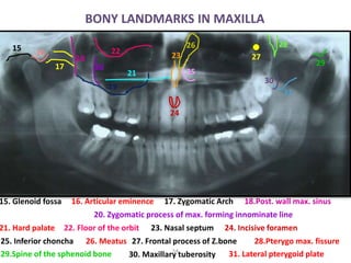 BONY LANDMARKS IN MAXILLA
54
15
15. Glenoid fossa
19. Floor of Max.Sinus
17. Zygomatic Arch16. Articular eminence 18.Post. wall max. sinus
20. Zygomatic process of max. forming innominate line
21. Hard palate 22. Floor of the orbit 23. Nasal septum 24. Incisive foramen
25. Inferior choncha 26. Meatus 27. Frontal process of Z.bone
16
17
18
19
20
21
22
23
29
25
24
26
28.Pterygo max. fissure
30. Maxillary tuberosity29.Spine of the sphenoid bone 31. Lateral pterygoid plate
31
30
28
27
 