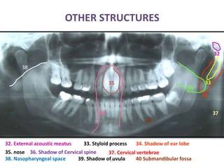 OTHER STRUCTURES
55
32
32. External acoustic meatus 34. Shadow of ear lobe33. Styloid process
35. nose 36. Shadow of Cervical spine
33
34
35
36 37
37. Cervical vertebrae
38
38. Nasopharyngeal space 39. Shadow of uvula
40
39
40 Submandibular fossa
 