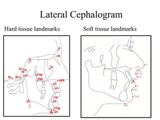 Lateral Cephalogram
Hard tissue landmarks Soft tissue landmarks
 
