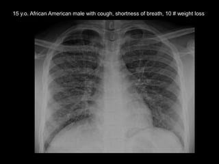 15 y.o. African American male with cough, shortness of breath, 10 # weight loss

 