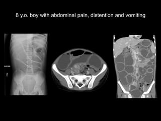 8 y.o. boy with abdominal pain, distention and vomiting

 