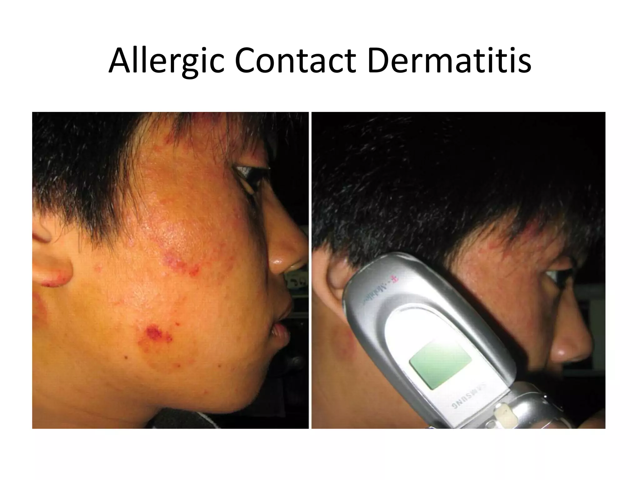 Pediatric rashes | PPTX