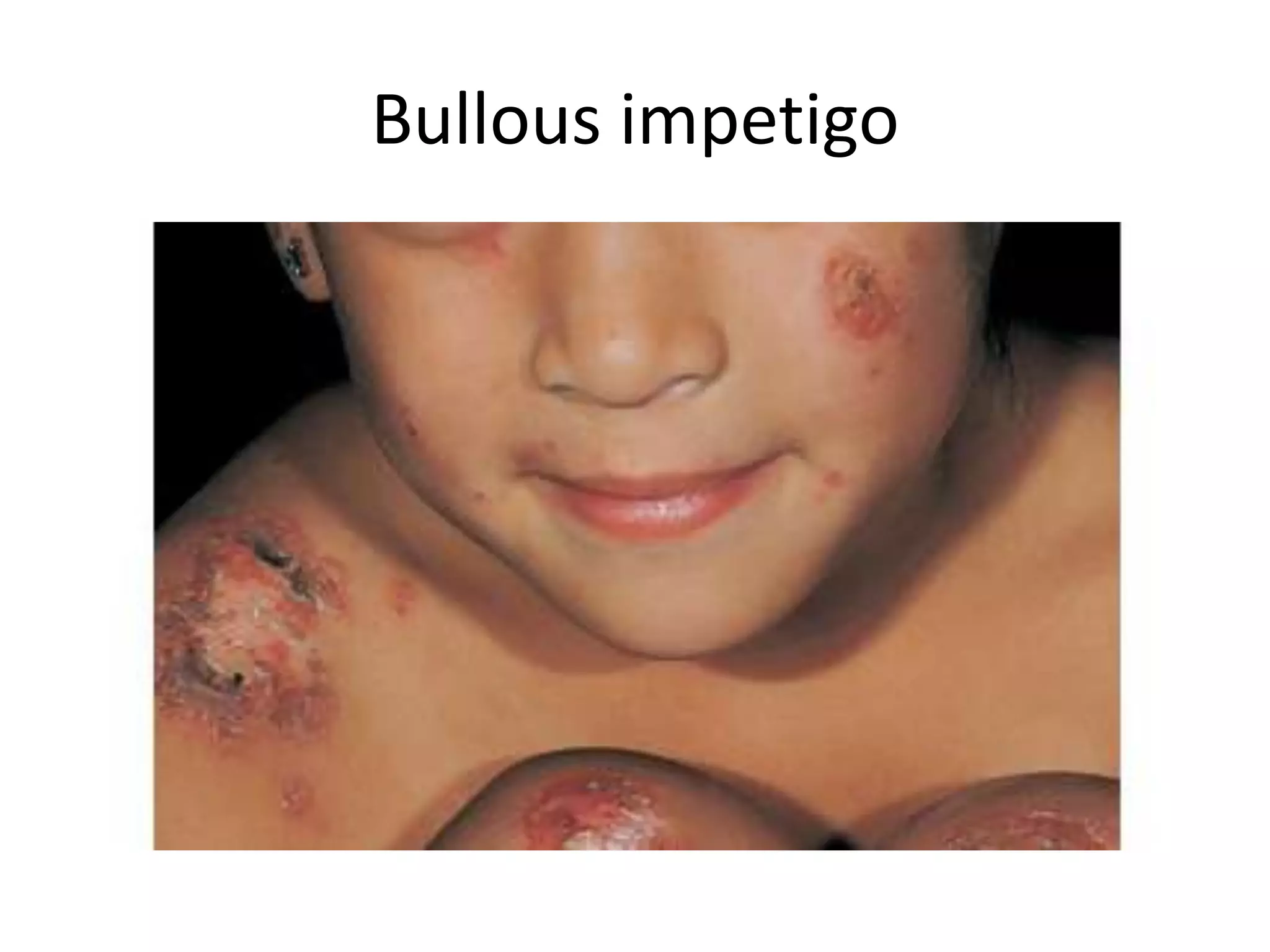 Pediatric rashes | PPTX
