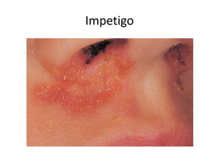 Impetigo Gu Rash Pediatric rashes | PPTX