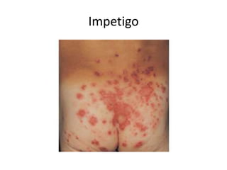 Invatago Pediatric rashes | PPTX