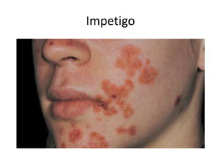 Invatago Pediatric rashes | PPTX