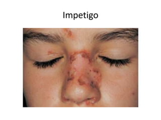 Invatago Pediatric rashes | PPTX