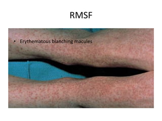 Rash Of Rmsf Pediatric rashes | PPTX