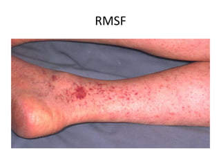 Pakistan Rash 62 Pediatric rashes | PPTX