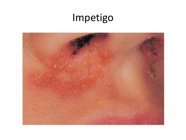 pediatric rashes