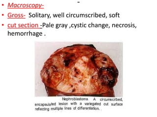 -
• Macroscopy-
• Gross- Solitary, well circumscribed, soft
• cut section -Pale gray ,cystic change, necrosis,
hemorrhage .
 