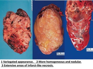 1 Variegated appearance. 2 More homogeneous and nodular.
3 Extensive areas of infarct-like necrosis.
 