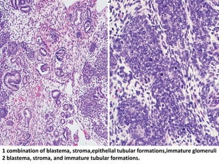 1 combination of blastema, stroma,epithelial tubular formations,immature glomeruli
2 blastema, stroma, and immature tubular formations.
 
