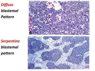 -
Diffuse
blastemal
Pattern
Serpentine
blastemal
pattern
 