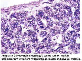 Anaplastic (“Unfavorable Histology”) Wilms Tumor. Marked
pleomorphism with giant hyperchromatic nuclei and atypical mitoses.
 
