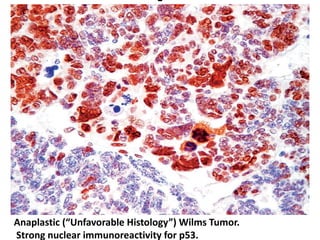 Anaplastic (“Unfavorable Histology”) Wilms Tumor.
Strong nuclear immunoreactivity for p53.
 
