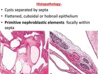Histopathology-
• Cysts separated by septa
• Flattened, cuboidal or hobnail epithelium
• Primitive nephroblastic elements focally within
septa
 