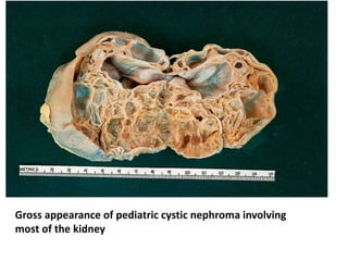 Gross appearance of pediatric cystic nephroma involving
most of the kidney
 
