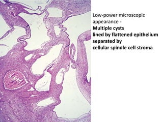 • .
Low-power microscopic
appearance -
Multiple cysts
lined by flattened epithelium
separated by
cellular spindle cell stroma
 