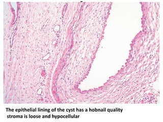 The epithelial lining of the cyst has a hobnail quality
stroma is loose and hypocellular
 