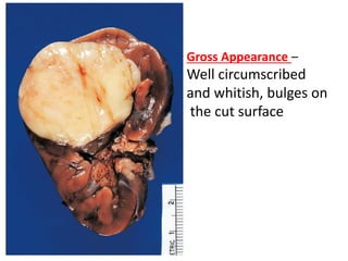 Gross Appearance –
Well circumscribed
and whitish, bulges on
the cut surface
 