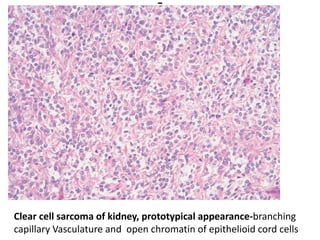 Clear cell sarcoma of kidney, prototypical appearance-branching
capillary Vasculature and open chromatin of epithelioid cord cells
 