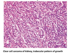 Clear cell sarcoma of kidney, trabecular pattern of growth
 