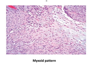 Myxoid pattern
 