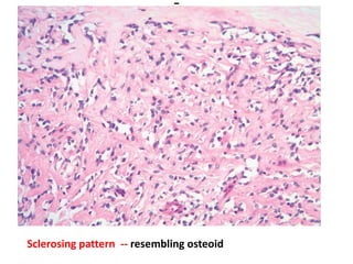 Sclerosing pattern -- resembling osteoid
 