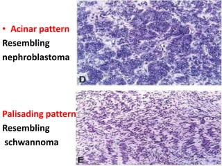 -
• Acinar pattern
Resembling
nephroblastoma
Palisading pattern
Resembling
schwannoma
 