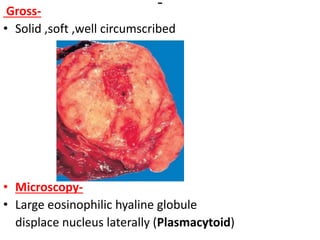 Gross-
• Solid ,soft ,well circumscribed
• Microscopy-
• Large eosinophilic hyaline globule
displace nucleus laterally (Plasmacytoid)
 