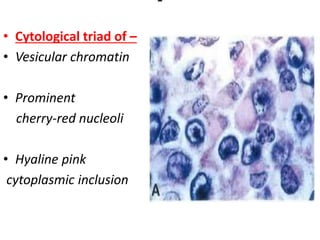 -
• Cytological triad of –
• Vesicular chromatin
• Prominent
cherry-red nucleoli
• Hyaline pink
cytoplasmic inclusion
 