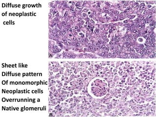 -
Diffuse growth
of neoplastic
cells
Sheet like
Diffuse pattern
Of monomorphic
Neoplastic cells
Overrunning a
Native glomeruli
 