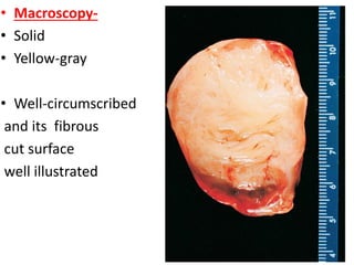 -
• Macroscopy-
• Solid
• Yellow-gray
• Well-circumscribed
and its fibrous
cut surface
well illustrated
 