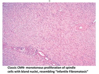 Classic CMN- monotonous proliferation of spindle
cells with bland nuclei, resembling “Infantile Fibromatosis”
 